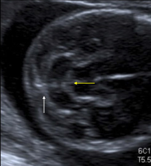 ultrasonido de espina bifida 12 semanas